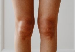 Jambes lourdes : rétention d'eau ou problème de circulation ?